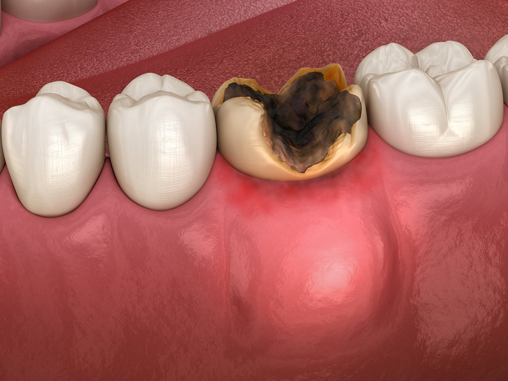 Tooth Extraction and Impaction Treatment